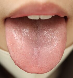 裂紋淡白舌