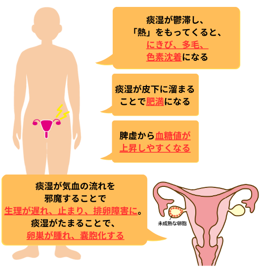 漢方からみた多嚢胞性卵巣症候群と痰湿の関係。